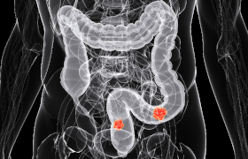 Genexpressieniveau kan prognose van colorectaal carcinoom helpen voorspellen