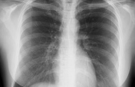 Cocktail of drugs speeds up treatment tuberculosis